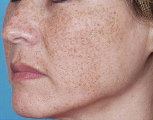 Everything You ve Ever Wanted To Know About Brown Spots And More